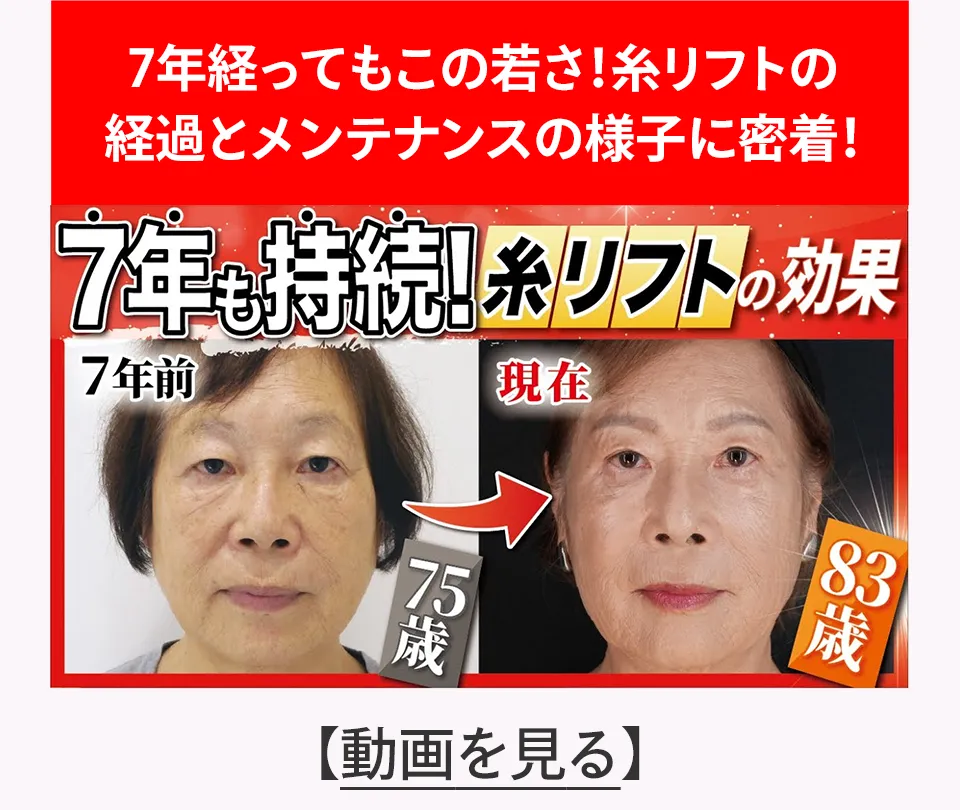 7年経ってもこの若さ！糸リフトの経過とメンテナンスの様子に密着！ 動画を見る