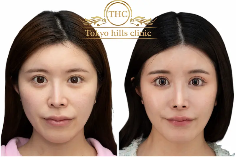 症例写真3 - ビフォーアフター