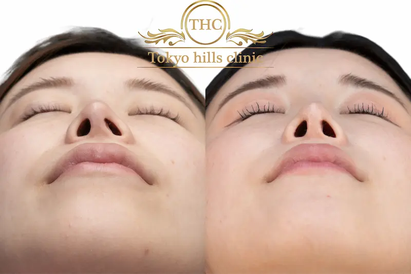 症例写真1 - ビフォーアフター